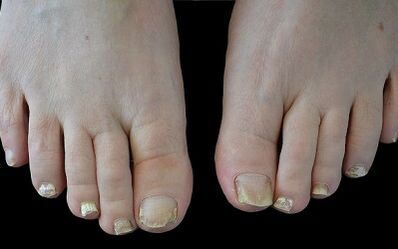 Hoe u de schimmel op uw vingers kwijt kunt