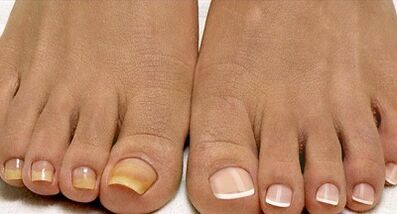 Fleet -schimmelbehandelingsmethoden