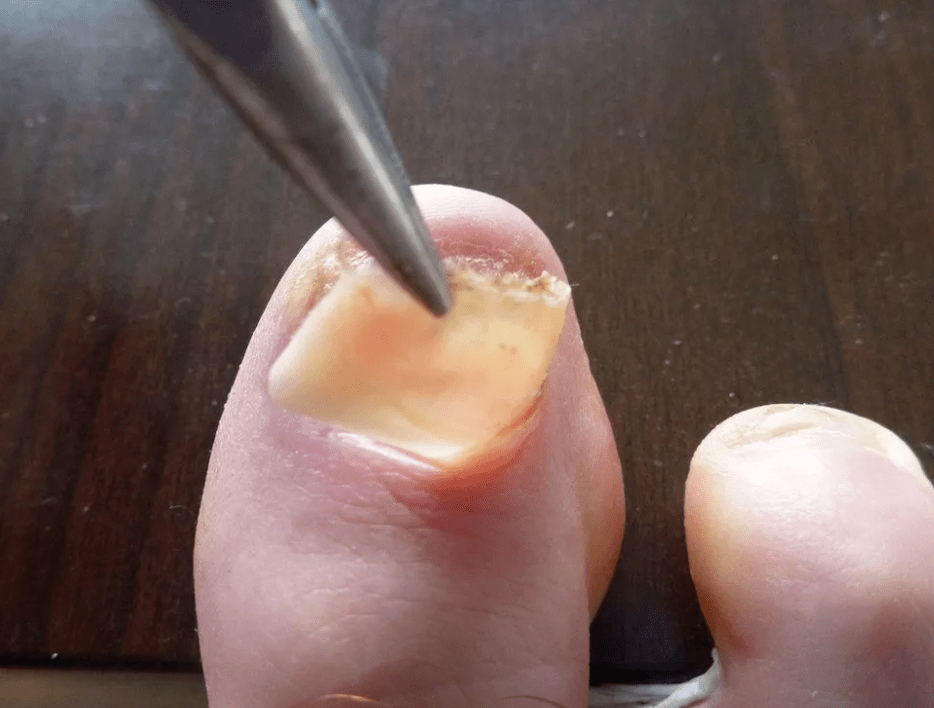 Verwijdering van de plaat