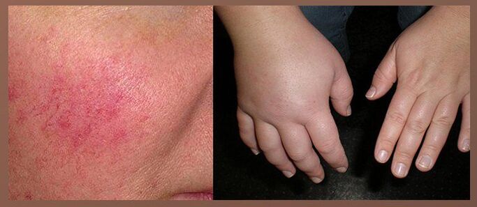 Bijwerkingen van druppels