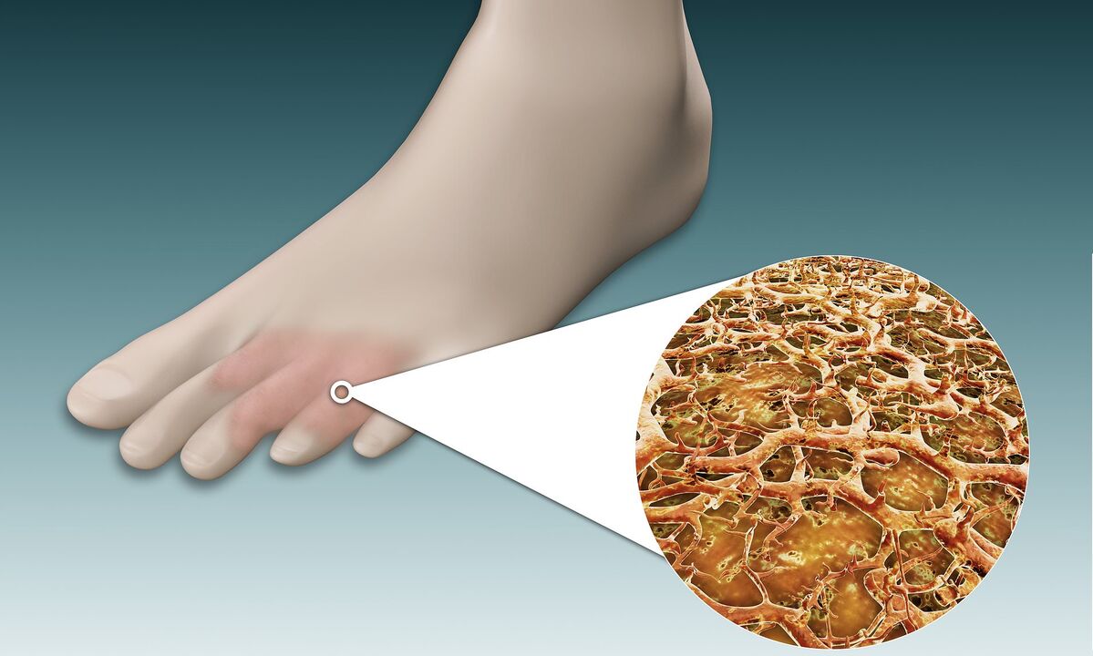 schimmelsporen op voeten